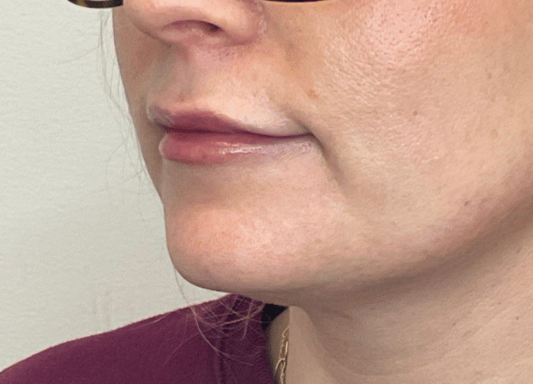 After Image: Lip Filler - left-front-oblique