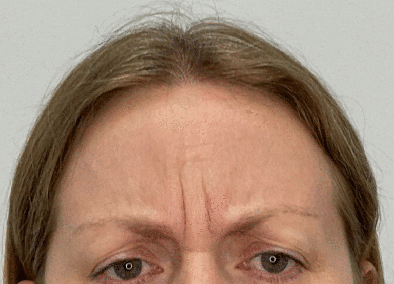 Before Image: Botox - front