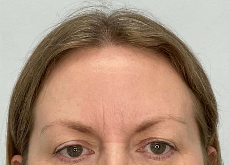 After Image: Botox - front