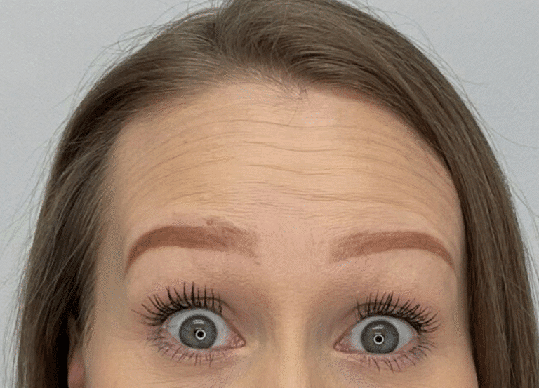 Before Image: Botox - front