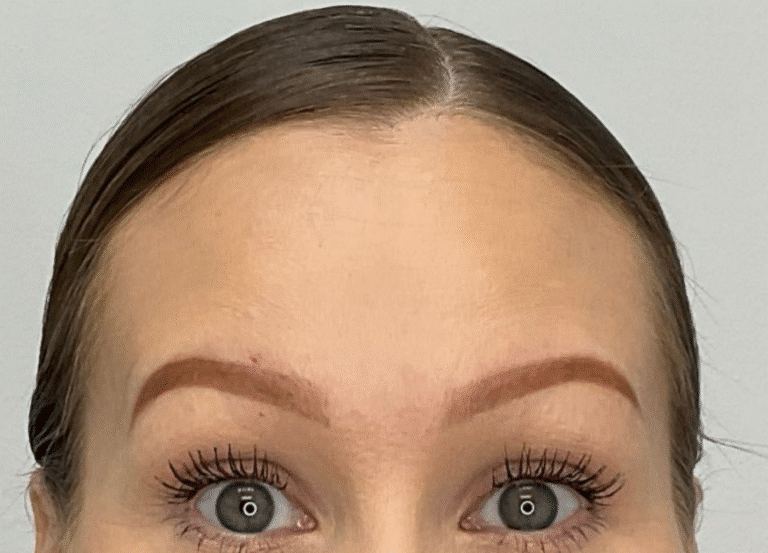 After Image: Botox - front