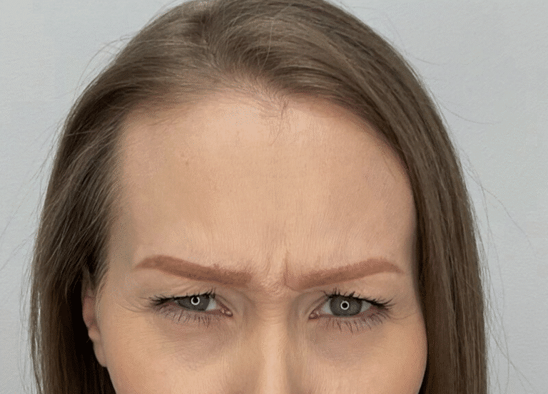 Before Image: Botox -