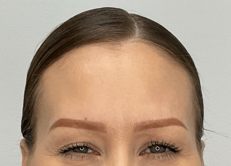 After Image: Botox -