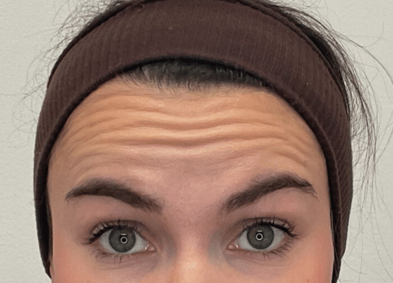 Before Image: Botox - front