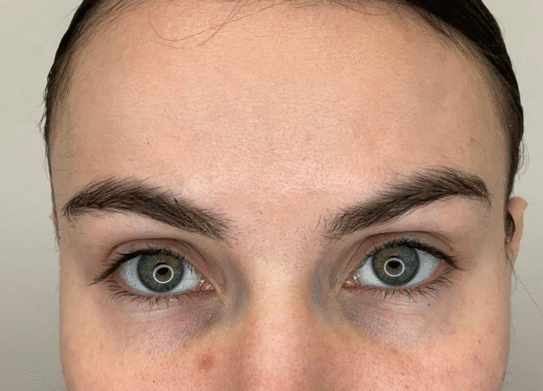 After Image: Botox - front