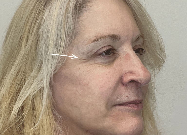 Before Image: Botox - right-front-oblique