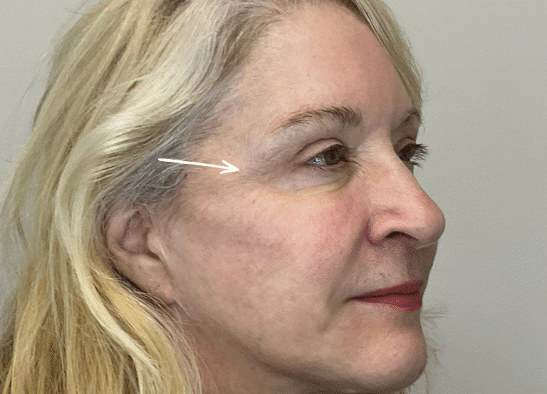 After Image: Botox - right-front-oblique