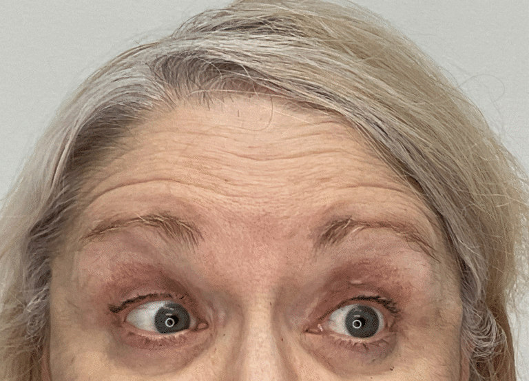 Before Image: Botox - front