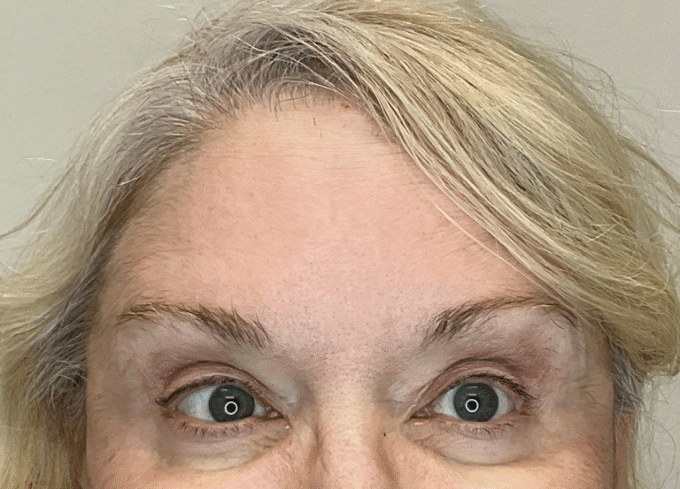 After Image: Botox - front