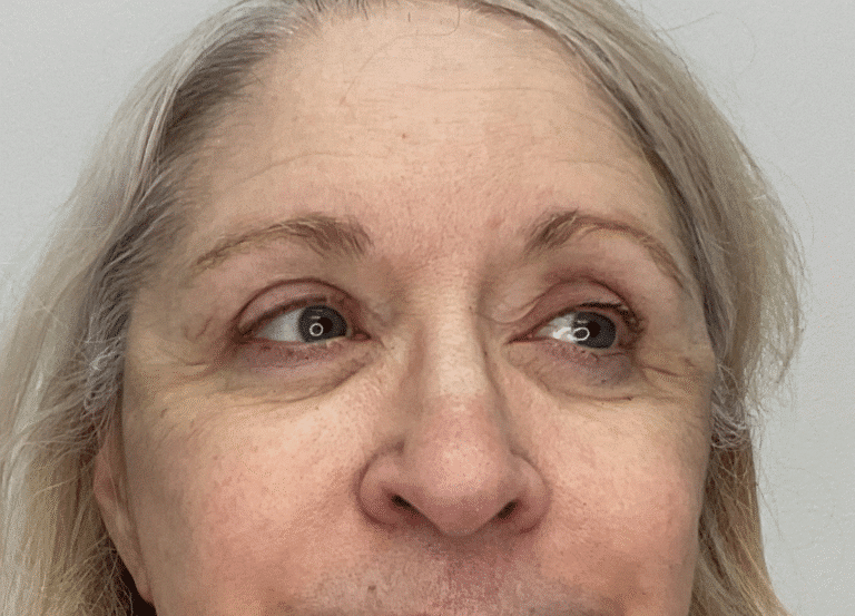 Before Image: Botox - front