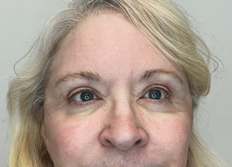 After Image: Botox - front