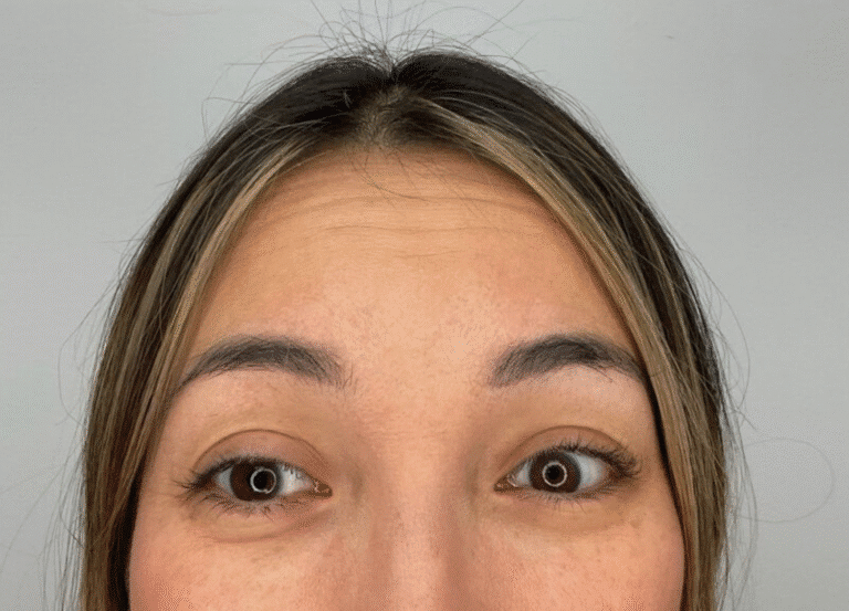 Before Image: Botox - front