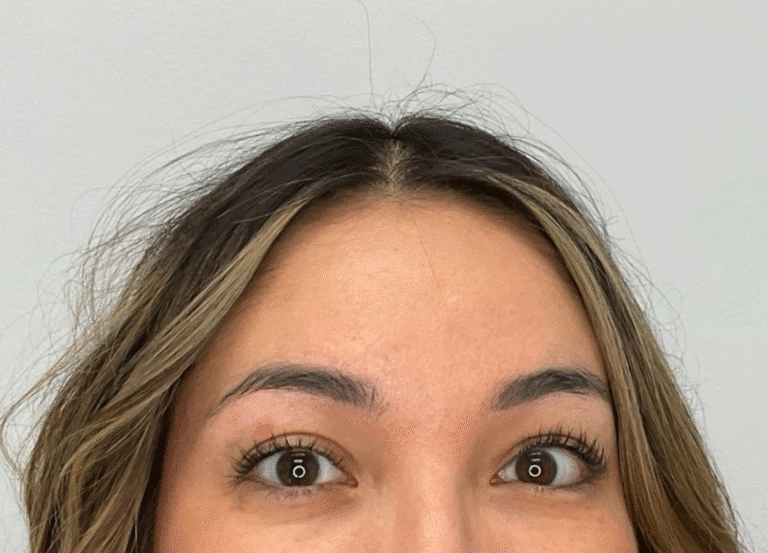 After Image: Botox - front