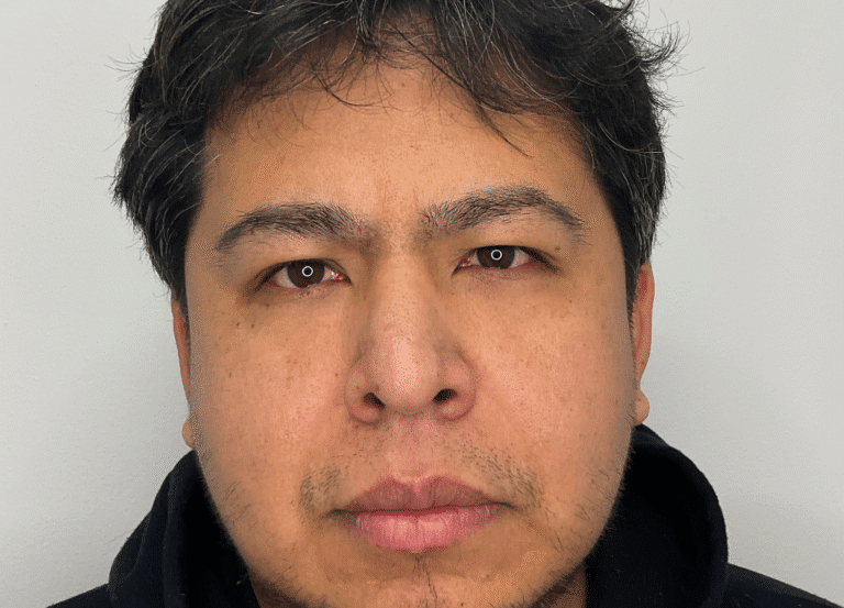 After Image: Botox - front