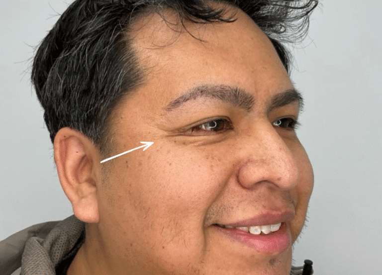 Before Image: Botox - right-front-oblique