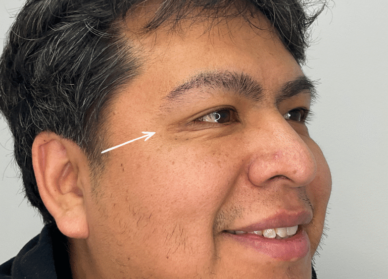 After Image: Botox - right-front-oblique