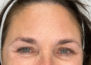 Before Image: Botox