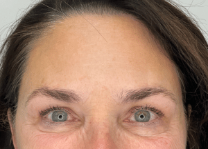 After Image: Botox