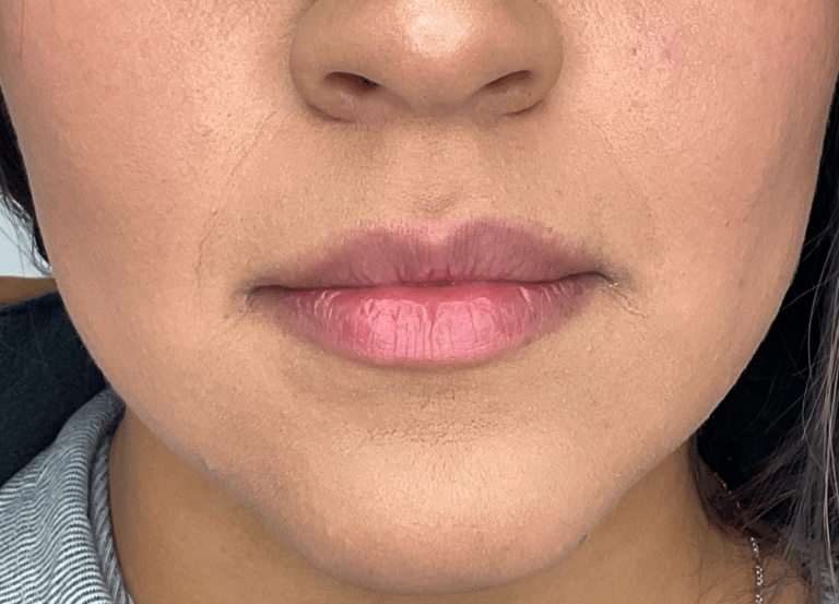 Before Image: Lip Filler - front