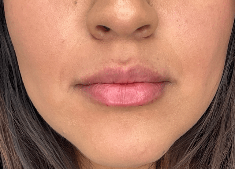 After Image: Lip Filler - front