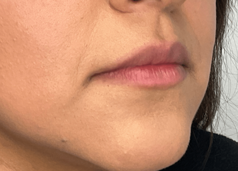 Before Image: Lip Filler - right-front-oblique