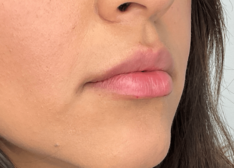 After Image: Lip Filler - right-front-oblique