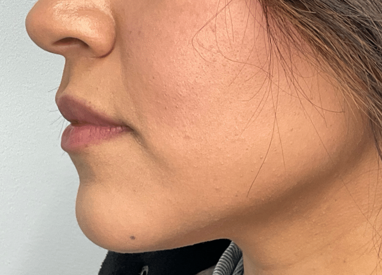 Before Image: Lip Filler - left-side