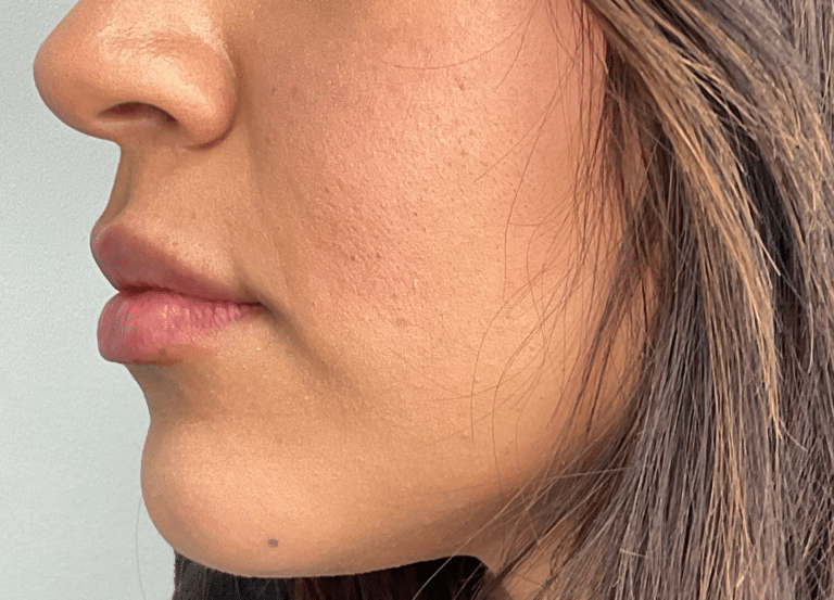 After Image: Lip Filler - left-side