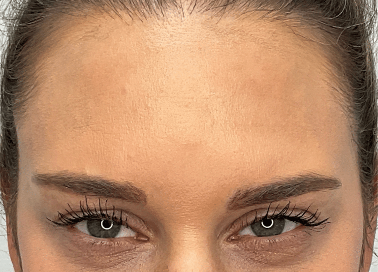 After Image: Botox - front