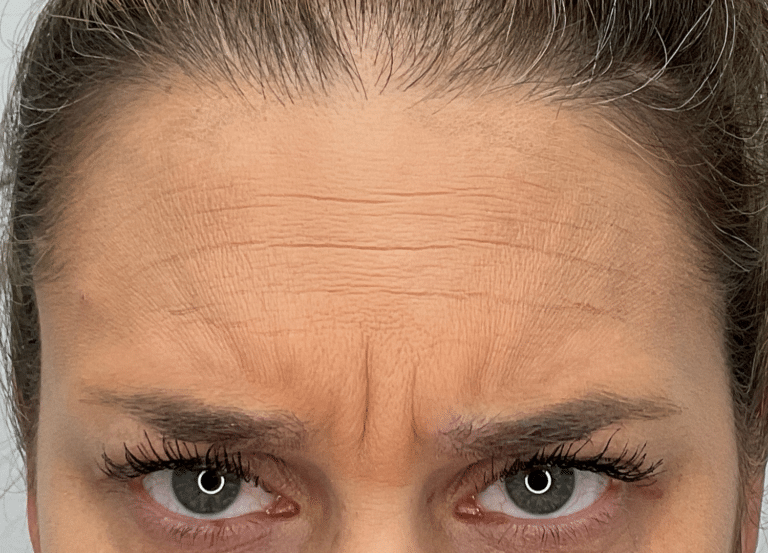 Before Image: Botox - front