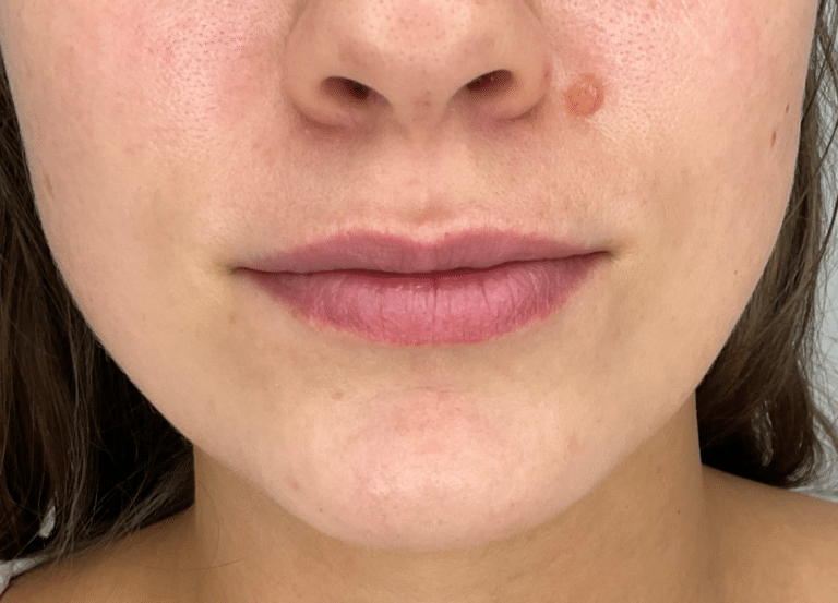 Before Image: Lip Filler - front