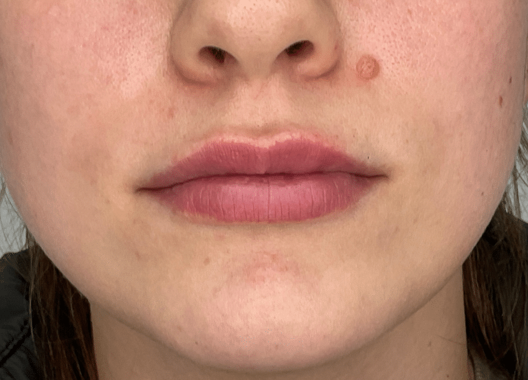 After Image: Lip Filler - front